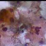 Διογκωμένοι υπερχρωματικοί και ανισομεγέθεις πυρήνες, 